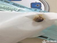 38岁男子鼻子酸臭取出幼时塞的异物,究竟是怎么一回事?_在线下载网资讯