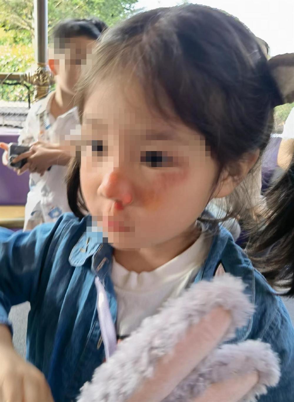 女童被黄牛恶意推倒致面部多处受伤 上海迪士尼：正在配合警方调查