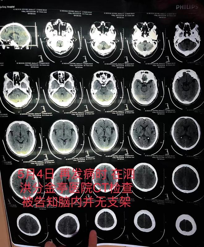 宿迁一患者因脑梗去世，医生承认此前未成功植入脑血管支架并隐瞒