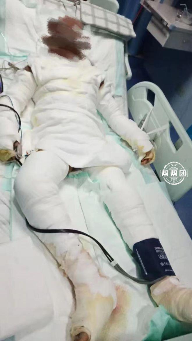 全身包满纱布的父亲躺在ICU里，用嘴型告诉女儿：先救妈妈！