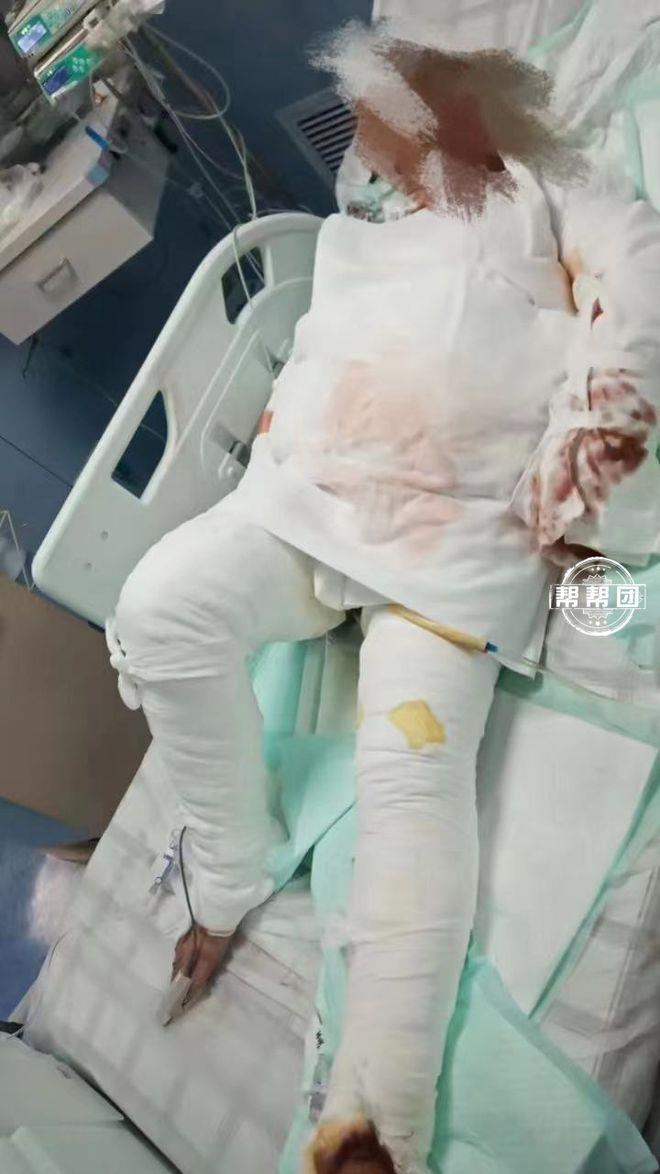 全身包满纱布的父亲躺在ICU里，用嘴型告诉女儿：先救妈妈！