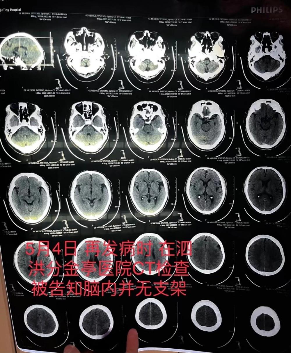 老人脑梗去世医生未植入支架却隐瞒：家属称已妥善处理，卫健委未回应