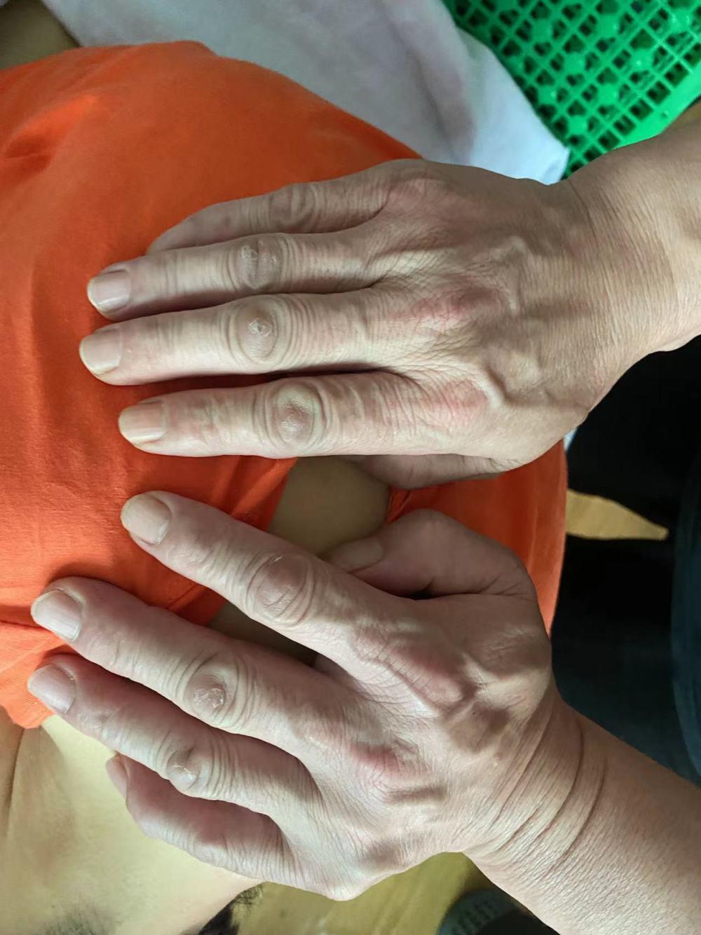 患渐冻症5年，她花了34000元，第三次雇凶杀自己