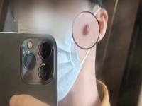 男生挤痘后流血近1小时,究竟是怎么一回事?